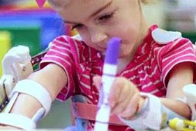 2 річній дівчинці створили екзоскелет за допомогою 3d